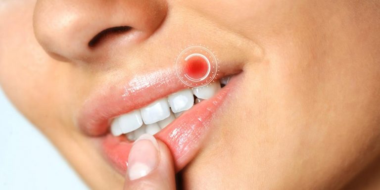HERPES SIMPTOMI I LEČENJE