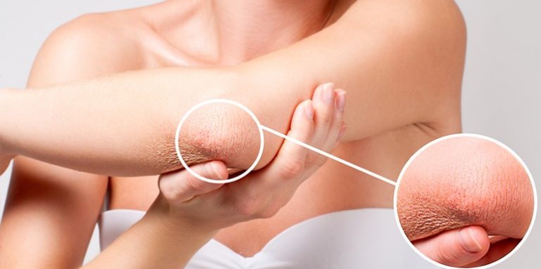 Rešite problem suve i ispucale kože ruku i laktova