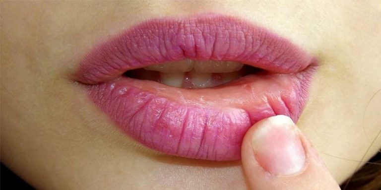 Bolesti usana (Heilitis) – uzroci, lečenje
