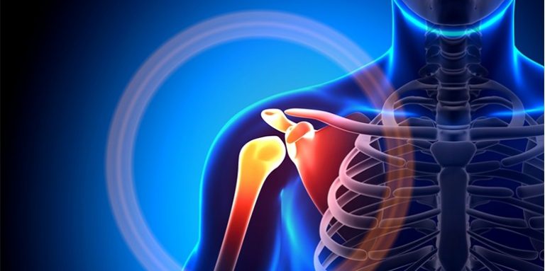 Bursitis i kalcifikat ramena – simptomi i lečenje