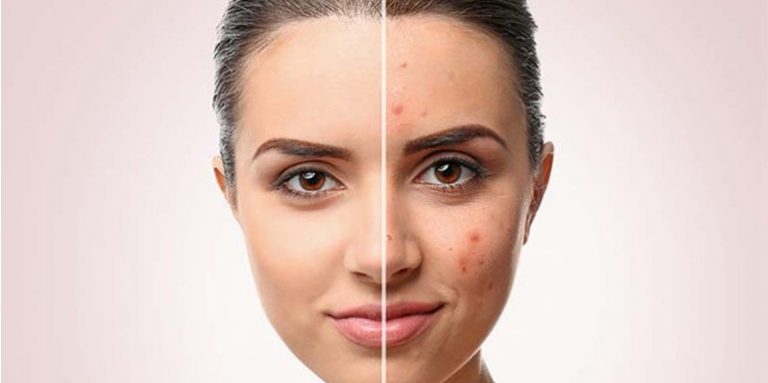 Akne na koži nisu samo kozmetički ili estetski problem, one duboko utiču na psihu