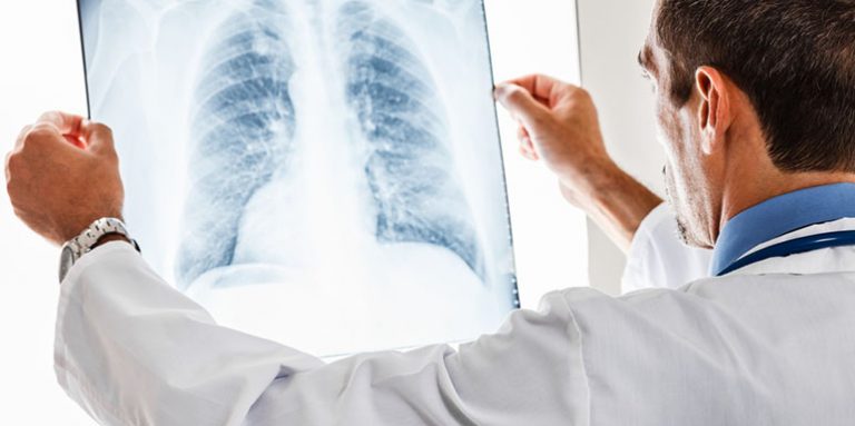 Plućna embolija – začepljenje plućne arterije
