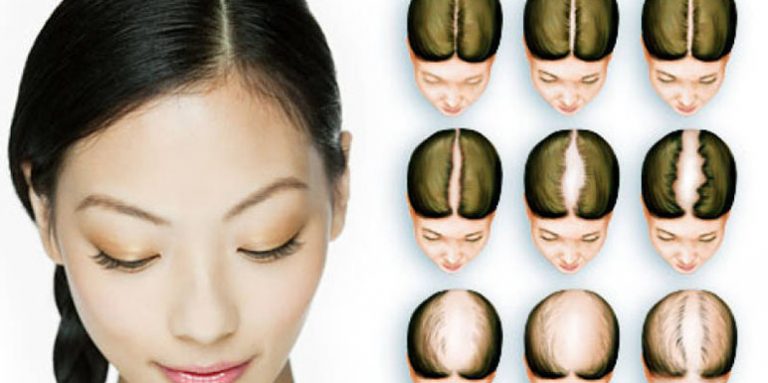 Ćelavost na pečate ili Alopecija – uzrok i lečenje