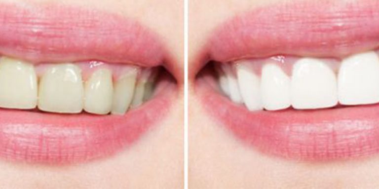 Kako izbeliti zube sa sastojcima koje imate kod kuće (5 recepata)