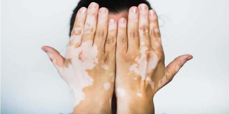 Nedostatak pigmenta – Kako se vitiligo leči?