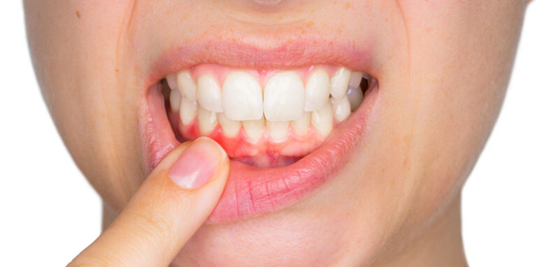 Kako se leči upala desni (gingivitis)